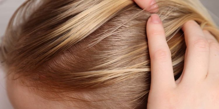 Alopécia androgenética: condição que afeta Xuxa também atinge mulheres e exige tratamento contínuo