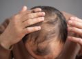 Lace e próteses capilares ajudam na estética, mas não substituem tratamento para alopécia, alerta Dr. Stanley Bessa