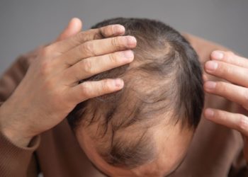 Lace e próteses capilares ajudam na estética, mas não substituem tratamento para alopécia, alerta Dr. Stanley Bessa