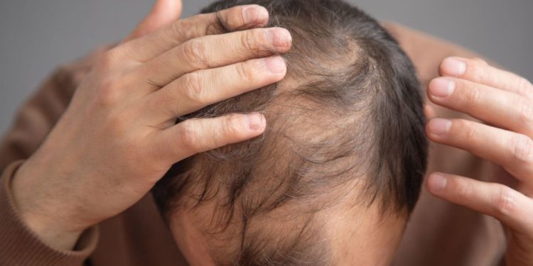 Lace e próteses capilares ajudam na estética, mas não substituem tratamento para alopécia, alerta Dr. Stanley Bessa