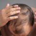 Lace e próteses capilares ajudam na estética, mas não substituem tratamento para alopécia, alerta Dr. Stanley Bessa